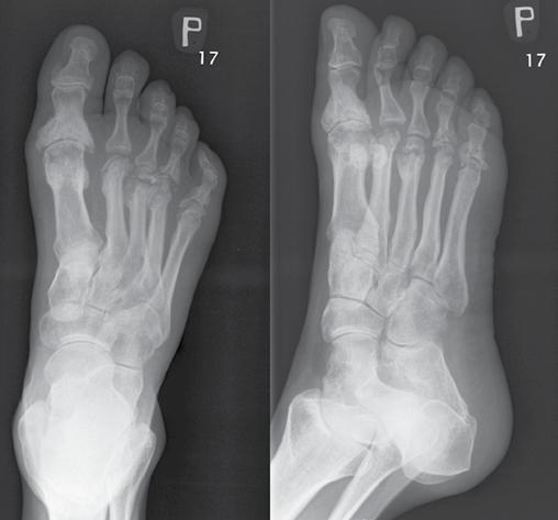 even fewer cases, the ankle joint and the calcaneus (29) (Fig. 7, Fig. 8, Fig. 9, Fig. 10, Fig. 11, Fig. 12).