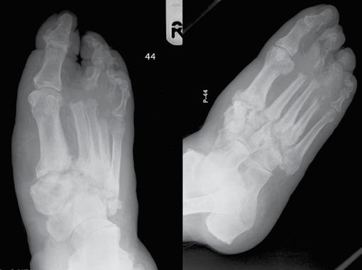 Radiographs of the right foot in the dorsiplantar and oblique views. Bone destruction within the tarsal bones in the course of Charcot arthropathy.