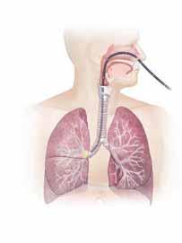 Other Procedures You may be advised to have certain procedures to show the inside of the lungs and the area around the lungs.