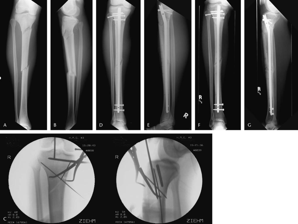 J Orthop Trauma Volume 20, Number 8, September 2006 Nailing of Proximal Tibial Fractures FIGURE 1.