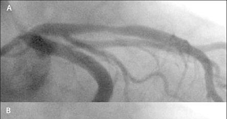 Late stent