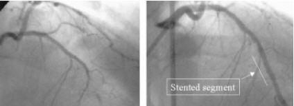 An unsuccessful trial - QuaDDS stent CONCLUSION: