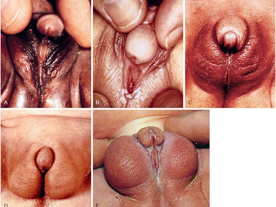 Ambiguous genitalia (Disorders of sex development); is any case in which the external genitalia do not appear completely male or completely female.