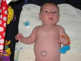 Umbilical granuloma The umbilical cord usually dries and separates within 6-8 days after birth.