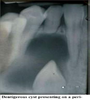 2- it may affect adjacent teeth by pressure and cause resorption of adjacent roots such as upper lateral incisors roots or upper first premolar roots.