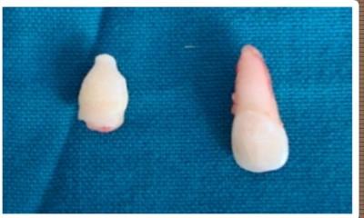supernumerary tooth and impacted