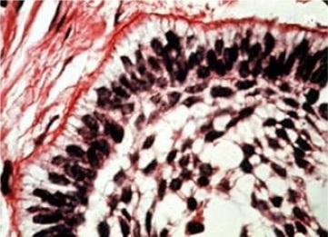 Histopathology: Many patterns 1- Follicular pattern Multiple follicles (follicle = solid nest) Peripheral cuboidal or columnar cells, central angular cells.