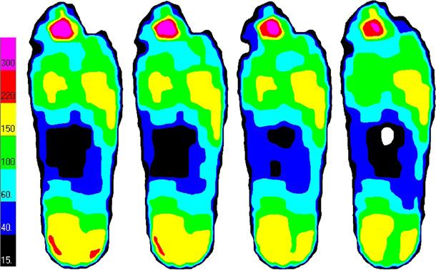 Pressure optimization in therapeutic footwear Figure 2 A C: Line graphs showing, for each ROI per foot location, the change in peak pressure from baseline to follow-up in-shoe pressure measurement as
