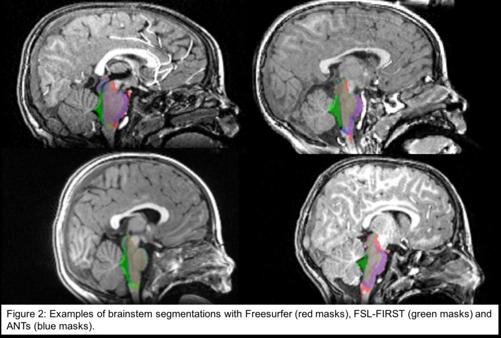 Figure 2: Examples of brainstem segmentations with Freesurfer (red masks), FSL-FIRST (green masks) and ANTs (blue masks).
