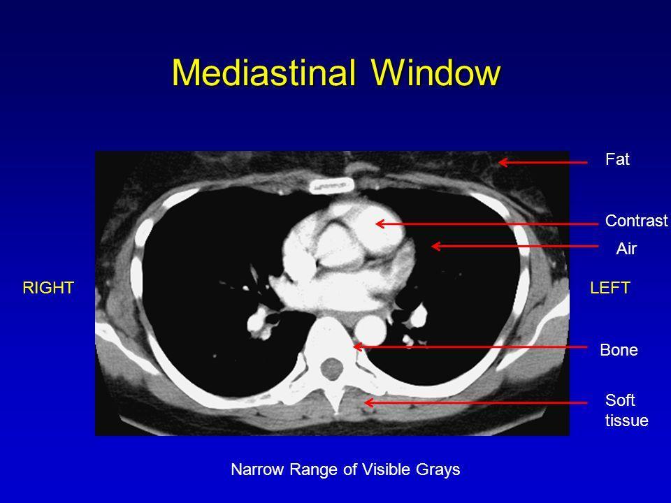 What would be the expected relatively white structures within the central part of these two black fields? The heart because it is soft tissue component. b. CT Scan: Wide VS Narrow windows: Lung Window X-Ray vs.