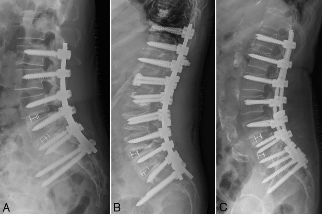 Y. S. Park et al. FIG. 2. Postoperative radiographs obtained in a patient from each of the 3 groups. A: UIV unicortical screw fixation (Group U).