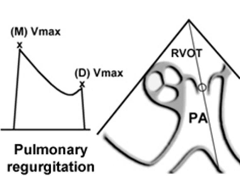 can be carried out like RVSP (in absence of RVOT obstruction), So RVSP = PASP.