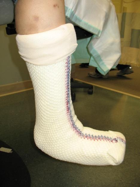 TCC Functional Attributes Allows for healing while ambulating Forced Compliance Immobilization, total contact with forefoot, arch, heel, Achilles tendon, and cone of lower leg.