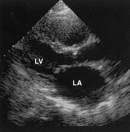 Mayo Clinic 1979-1996 Echocardiographic criteria: Biatrial enlargement Nondilated ventricles Normal wall thickness Exclusion criteria: - IHD, HT(>5 years), VHD, congenital, - pericardial disease,