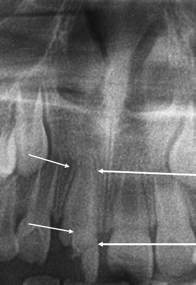 Case Report A 9-year-old girl presented at the Department of Conservative Dentistry and Endodontics of the University of Cagliari.