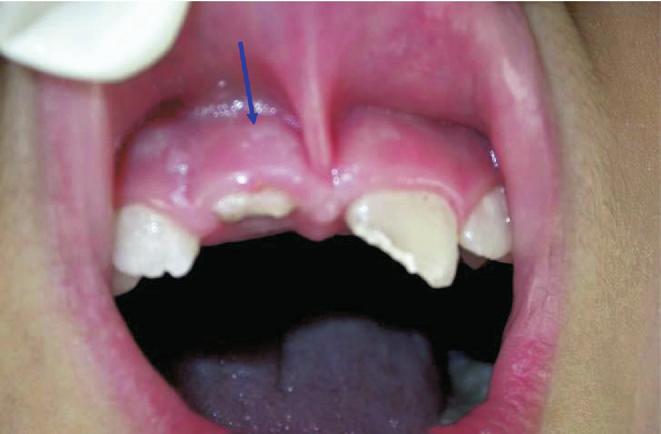 She did not have symptoms immediately after the accident, but subsequently she reported losing coronal fragments from the maxillary right central incisor. They then decided to visit a dentist.
