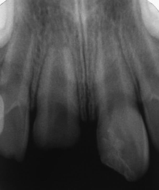 Figure 3. Periapical radiograph showing tooth #8 after the removal of the fragments of the fractured crown (September 2004). Figure 4.