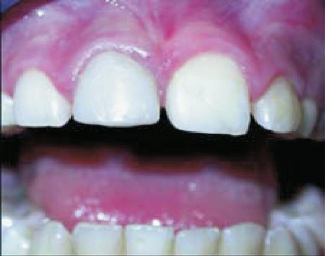 Figure 7. Photograph showing tooth #8 with composite restoration at 24-month recall. cin paste were used as an intracanal medication.