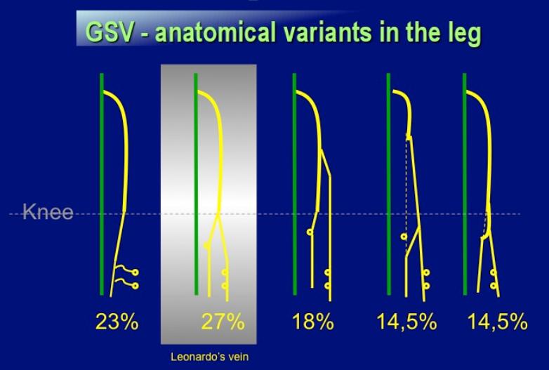 Normal GSV with GSV with Aplastic GSV GSV Leonardo s vein Large