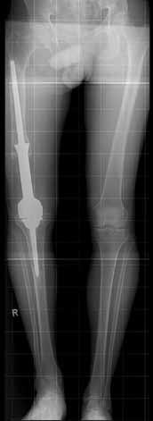 (Figure 1). The prosthesis is made entirely of cobalt-chromium alloy, the hexagonally shaped part of which is coated with a layer of plasmasprayed titanium. This is to encourage bone on-growth.