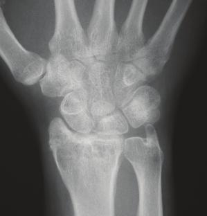 closed means (Fig. 2.9). The radial styloid fragment is reduced with ligamentotaxis and temporarily held with K-wires.