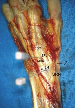 14 D. J. Slutsky a b c Fig. 2.1 Dorsal portal anatomy. (a) Cadaver dissection of the dorsal aspect of a left wrist demonstrating the relative positions of the dorsoradial portals.