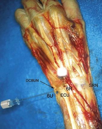 EDM extensor digiti minimi; DCBUN dorsal cutaneous branch of the ulnar nerve. (c) Positions of the 6R and 6U portals (Copyright by Dr.