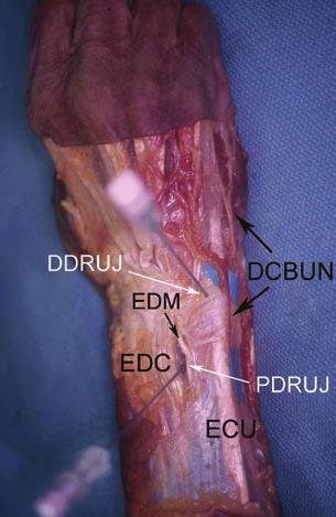 16 D. J. Slutsky Fig. 2.4 Dorsal DRUJ portal anatomy. (a) Relative position of the proximal (PDRUJ) and distal (DRUJ) portals.
