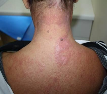 erythematous papules and plaques for 2 months Present illness: Two months, he
