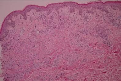 Skin examination Multiple erythematous papules coalescing into large annular