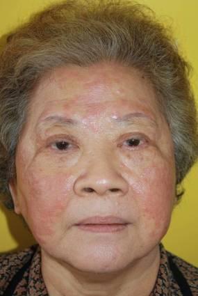 Present illness: The patient noticed pink papules with centrifugal enlargement on both cheeks,