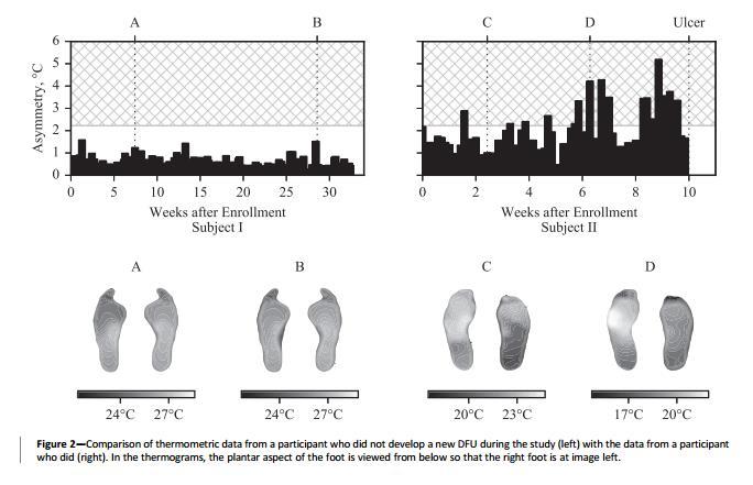 Results Case Examples 61-year-old male History L Hallux DFU Healed 40 weeks History R Hallux Amp Healed 42 weeks At no time during the study did he exceed asymmetry temperature
