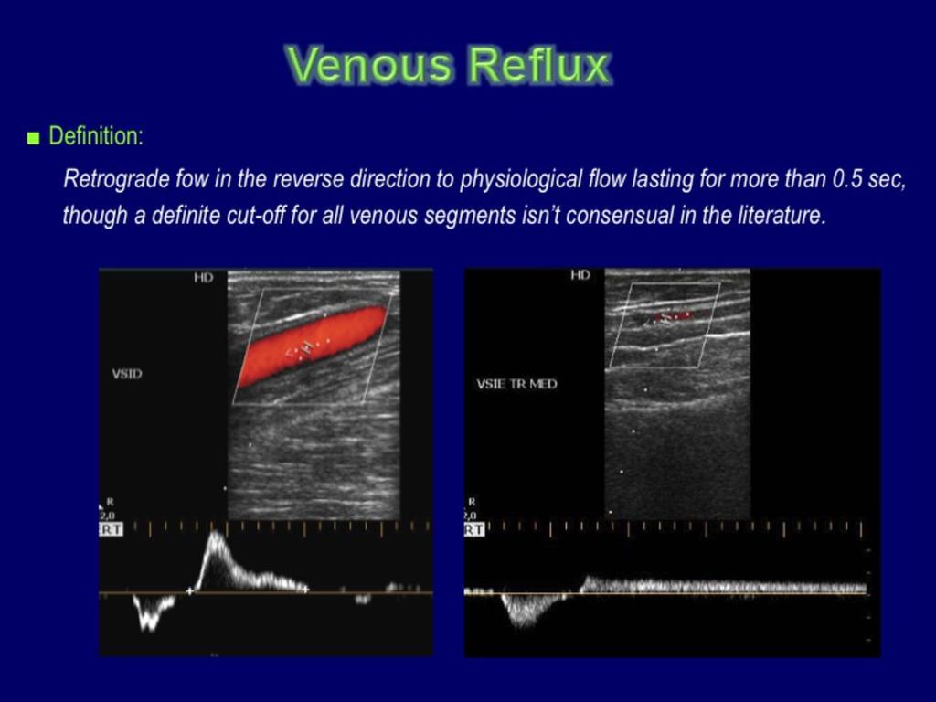Fig.: Physiological Venous Terms There are different methods for elliciting venous reflux;