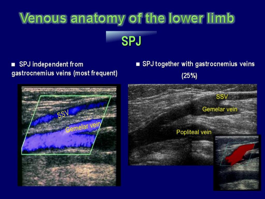 Fig.: The saphenopopliteal junction In the presence of saphenous vein reflux, it is important to provide detailed anatomical information on the location of the SPJ, since