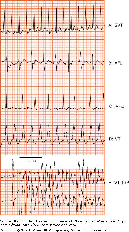 ECG of some
