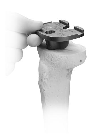 Zimmer NexGen MIS Tibial Component Cemented Surgical Technique 5 During broaching, make sure that the broach handle remains flush against the sizing plate and in full contact with the sizing plate