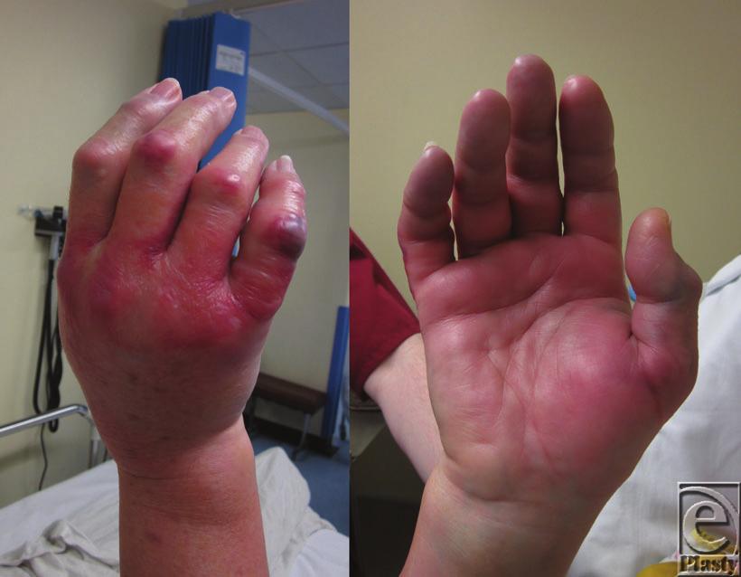eplasty VOLUME 14 Figure 2. Dorsal and palmar aspect of the hand showing signs of compartment syndrome of the right hand.