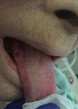 Case 3 71 yo woman with adult-onset asthma presents with acute