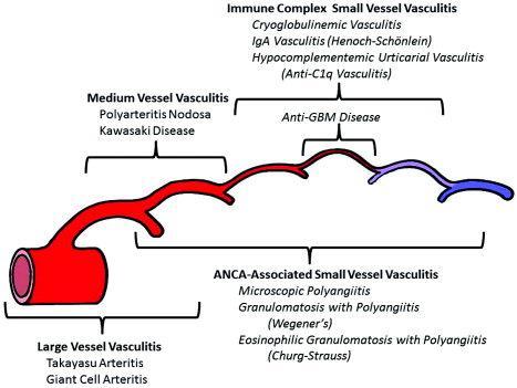Vasculitis schema by vessel size