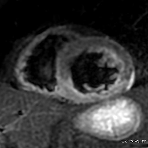 male 72 years, acute infero-lateral ST-segment