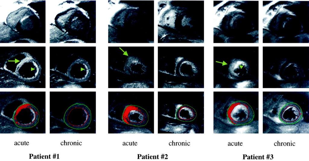 DE and T2w CMRI Differentiate acute from chronic MI Group A (15 pts) with acute reperfused MI, Three patients in group A