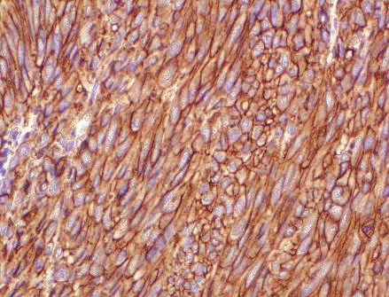 KIT-positive spindle cell GIST. KIT-positive epithelioid cell GIST. Figure 7. GIST samples viewed at 200X magnification with brown staining indicating positive results for KIT immunohistochemistry.