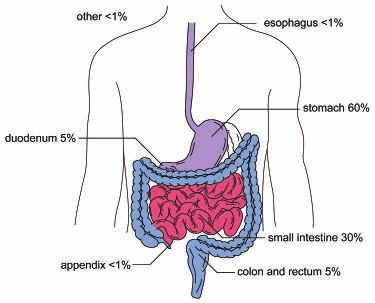 What is a GIST? Gastrointestinal stromal tumor (GIST) is a rare cancer usually affecting the digestive tract or occasionally nearby structures within the abdomen. GIST is a type of sarcoma.
