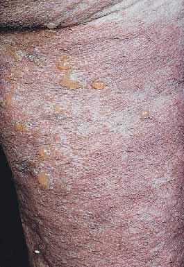 Bullous colon lesions in a patient with bullous pemphigoid Evelyn Maria Sachsenberg-Studer, MD, Ulf Runne, MD, Till Wehrmann, MD, Manfred Wolter, MD, Susanne Kriener, MD, Knut Engels, MD, Thomas