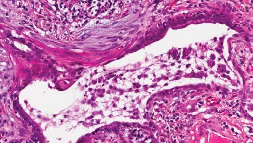 a) b) FIGURE 2 a) Low magnification histopathological biopsy showing typical features of usual interstitial pneumonia pattern with a heterogeneous appearance and areas of fibrosis with scarring and