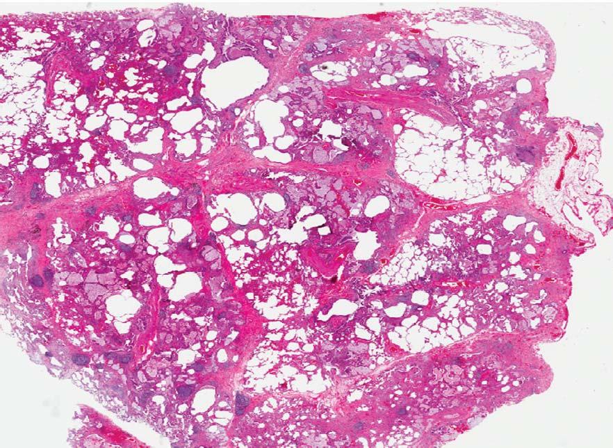 b) Higher magnification of the histopathological biopsy reveals diffuse pulmonary involvement of numerous macrophage accumulations within most of the distal airspaces, consistent with a desquamative
