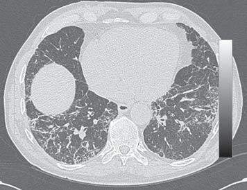 a) b) FIGURE 4 Chest high-resolution computed tomography scans performed on a) August 16, and b) September 4,. been described.