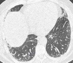 a) b) c) d) e) f) FIGURE 5 Initial high-resolution computed tomography scans performed in November showing mild reticulation and sub-pleural honeycombing.