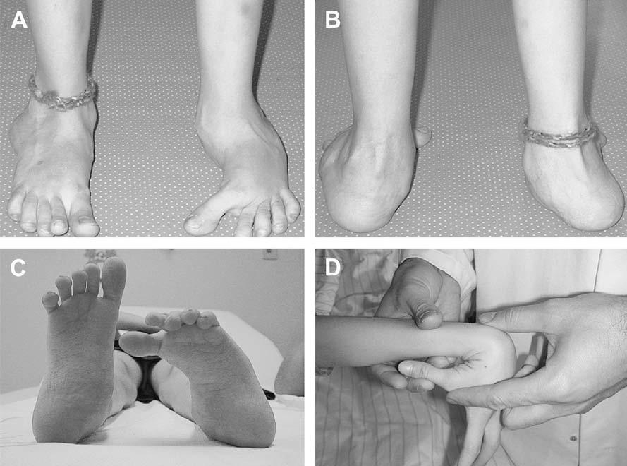 Classification Congenital idiopathic type - Supple deformity, very little rearfoot valgus - Resolve with time Associated with syndrome or