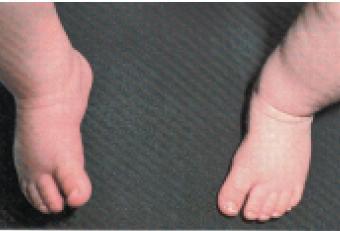 Clinical evaluation On inspection Toe angles abruptly toward midline C-shaped lateral foot border